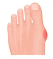 Exemple de pied avec un Hallux Valgue