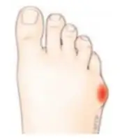 Exemple de pied avec un Quitus Varus